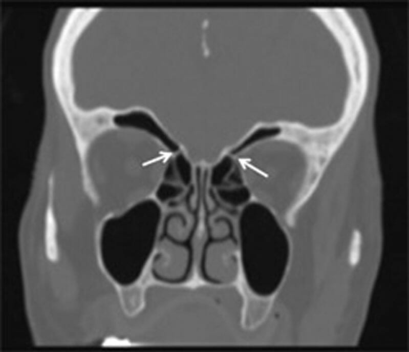 Nasal Anatomy - SinusHealth