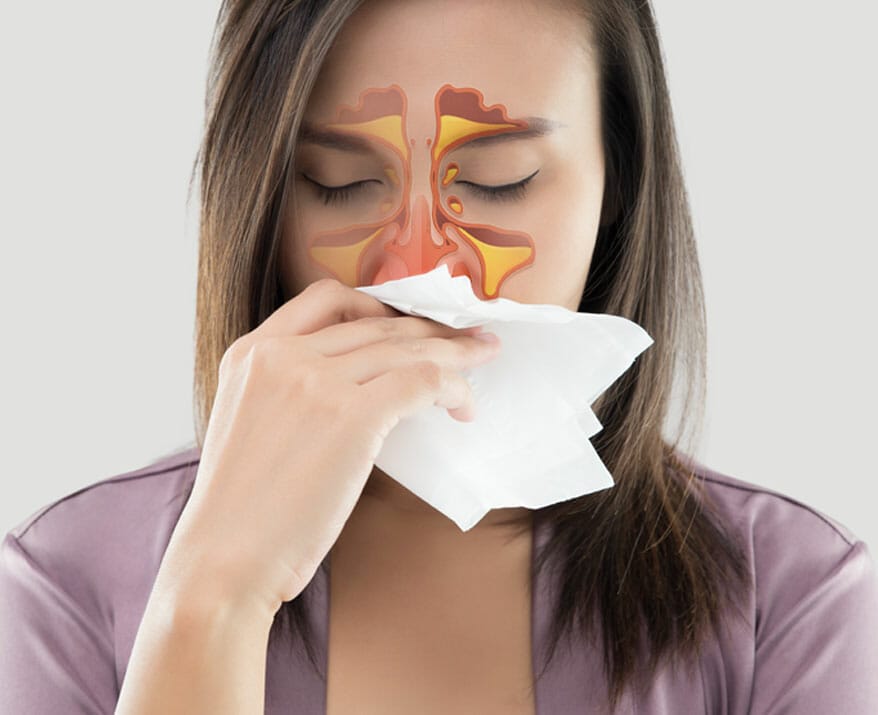 Sinus Infection (Sinusitis): Causes, Symptoms & Treatment