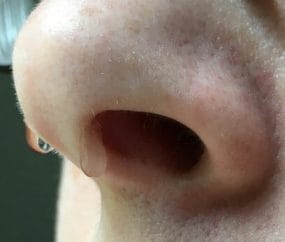 Nose leaking clear fluid and CSF rhinorrhea