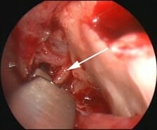 Endoscopic SPA Ligation