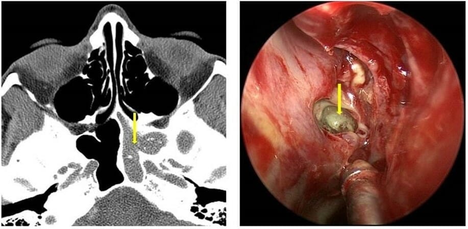 Fungal sinus store infection