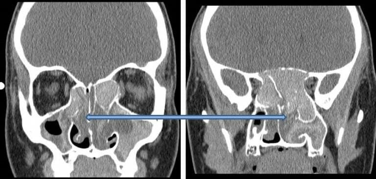 Fungal Sinusitis - SinusHealth