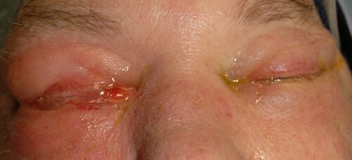 Complications of Sinusitis SinusHealth