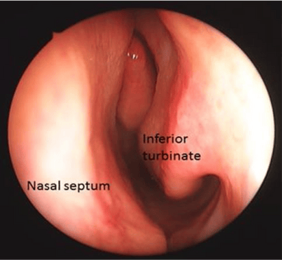 septoplasty and turbinate reduction