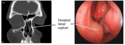 Image demonstrates CT scan and endosasal appearance of a deviated septum