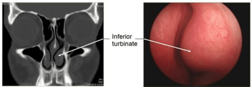 Image shows the appearance of an enlarged inferior turbinate on a CT scan and an endoscopic imageFigure 3. CT scan and photo of enlarged inferior turbinates on the left side of the nose