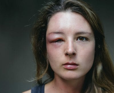 woman with swollen eye from complication of sinus infection