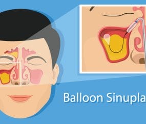 animation of how balloon sinuplasty works