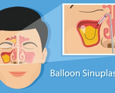 animation of how balloon sinuplasty works
