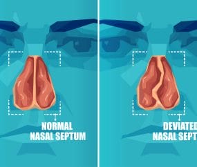 Shows difference between a normal nasal septum and a deviated nasal septum