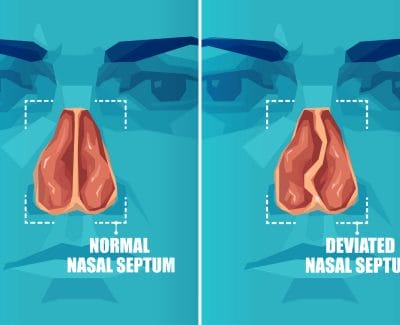 Shows difference between a normal nasal septum and a deviated nasal septum