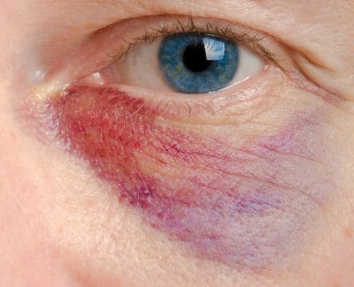 Bruising around an eye from sinus surgery complicationom injury