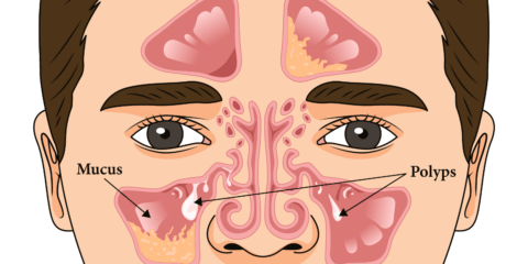 When is a biologic indicated for chronic rhinosinusitis with nasal ...