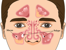 Diagram of a face depicting a person with chronic sinusitis, sinus inflammation, trapped mucous, and nasal polyps